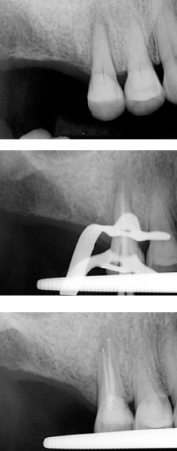 Root-canal-Treatment